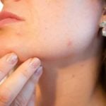 Cure Acne with Healthy Lifestyle