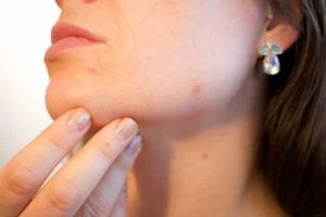 Cure Acne with Healthy Lifestyle